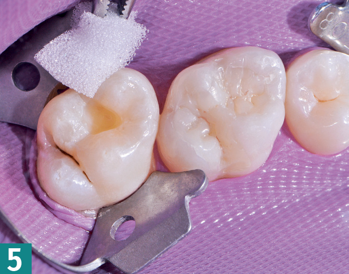 Реставрация DMG Constic - этап 5